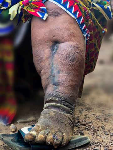 The limb of a woman suffering from elephantiasis in Makoto, Bombali