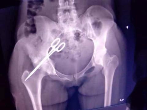 Scan of the scissors inside the woman